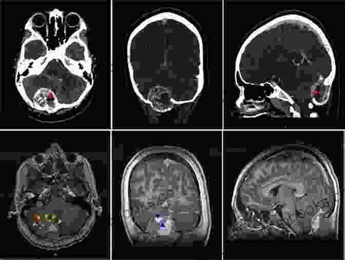 MRI Scan Of A Skull Base Tumor, Demonstrating Its Intricate Location And Relationship With Surrounding Structures Comprehensive Management Of Skull Base Tumors