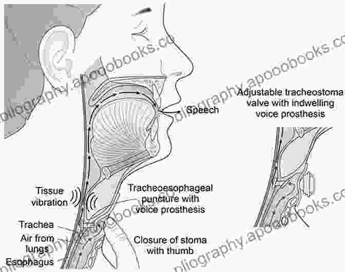 The Laryngectomee Guide Book Cover, Featuring A Person With A Laryngectomy Tube Speaking The Laryngectomee Guide Itzhak Brook M D